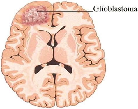 Glioblastoma Multiforme Explained – Boston Neurosurgery