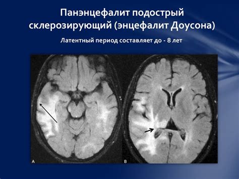 Подострый-склерозирующий-панэнцефалит (Ван-Богарта) - презентация онлайн