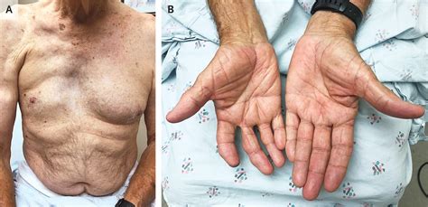 Синдром. Поланда синдром (Poland syndrome). + | Портал радиологов
