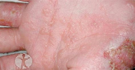 Dyshidrotic eczema (pompholyx) image