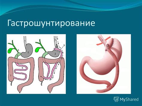 Презентация на тему: "Ожирение – это хроническое нарушение обмена ...