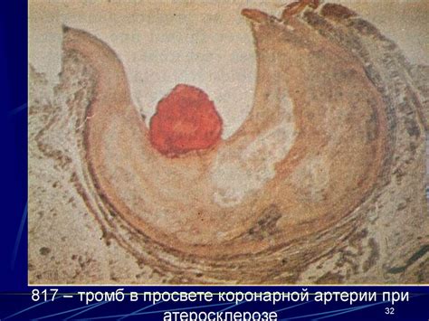 Заболевание атеросклероз. (Лекция 16) - презентация онлайн