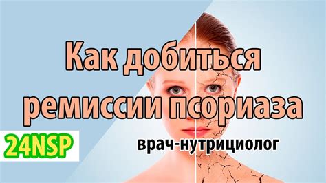Как добиться стойкой ремиссии при псориазе? Лечение псориаза от врача ...