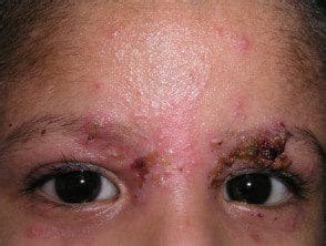 Eczema herpeticum - Hoogstra - Medical Centers