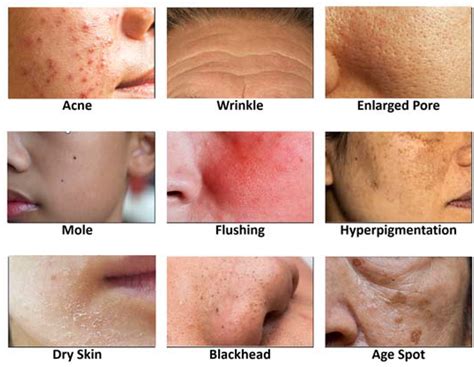 Skin Moles Types