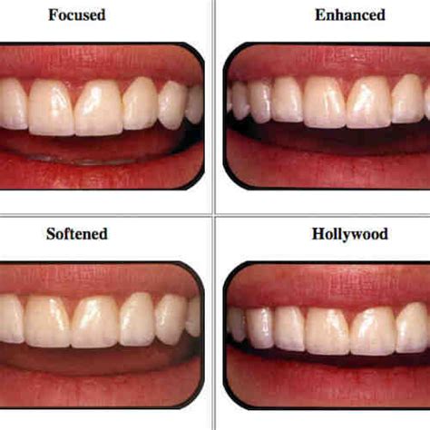 Cosmetic dentistry sharp teeth - Dental News Network