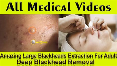 Blackhead Removal Videos May 2024 - Rhody Kristine