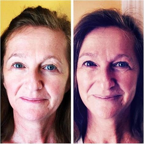 Microcurrent Treatment Before And After (7) » Facelift: Info, Prices ...
