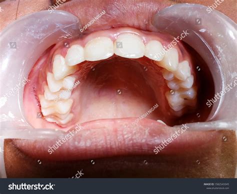 photo showing front teeth  mouth stock photo