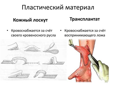 Кожная пластика - презентация онлайн