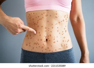 Woman Body Skin Rash Red Allergy Stock Photo 2211535089 | Shutterstock