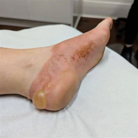 prevent blisters  feet posture podiatry