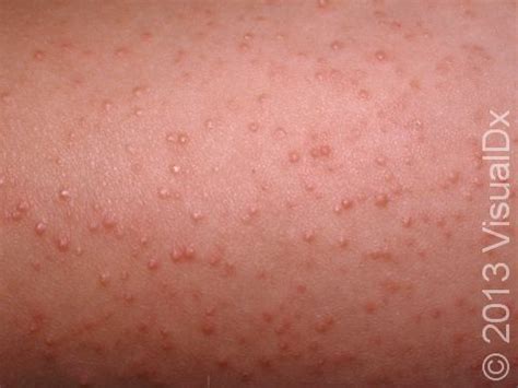 Itchy Bumps On Arms