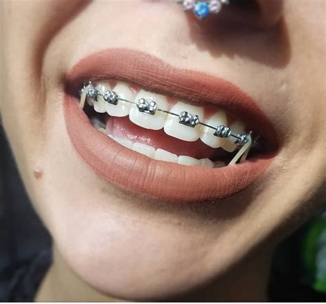 √ Cutest Braces Colors