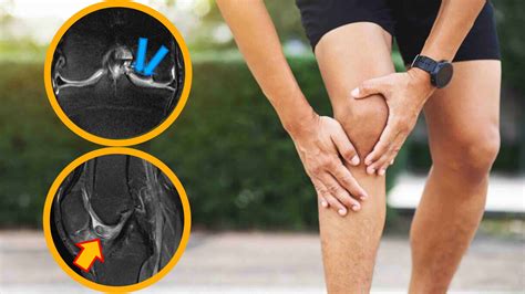 dor  joelho ao dobrar clinica  joelho