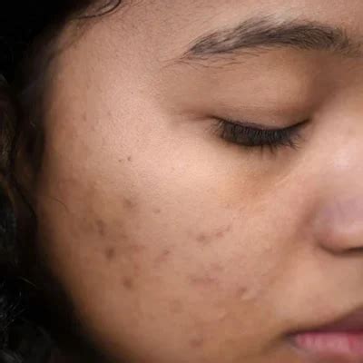 A Comprehensive Guide to Acne Scars: Causes, Symptoms, and Treatment