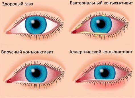 Кон'юнктивіт у дитини
