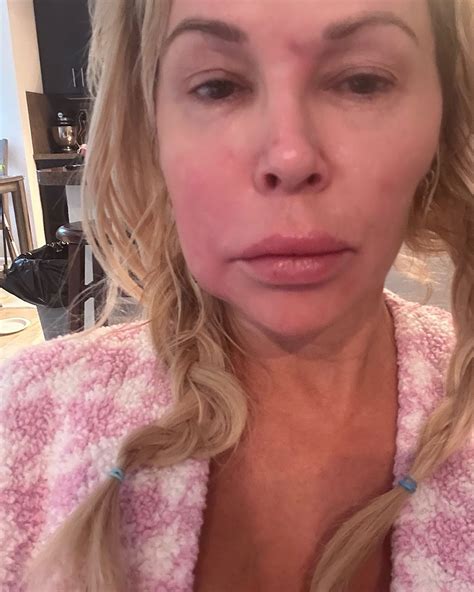 Brandi Glanville's Health Battle: Facial Disfigurement, Diagnosis, More