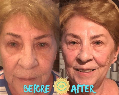 face lift healing time 8