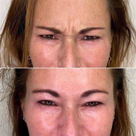 Fronsrimpel met Botox - Laurium Klinieken