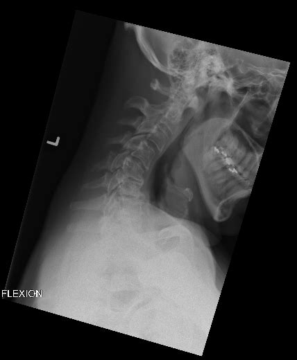 Flexion-Extension X ray of 2018