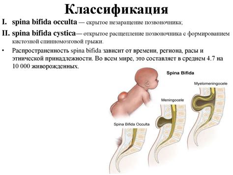 Спинальные дизрафии - презентация онлайн