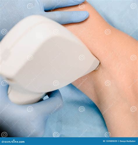 laser underarm hair removal 12