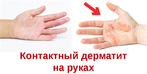 Контактный дерматит: фото, причины, симптомы, и лечение