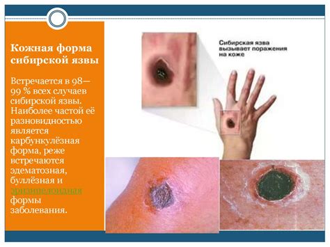 Сибирская язва - презентация онлайн