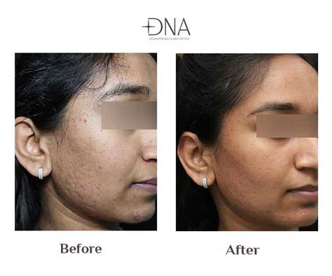 Acne Scar Treatment in Bangalore | Acne Scar Treatment Cost in Bangalore