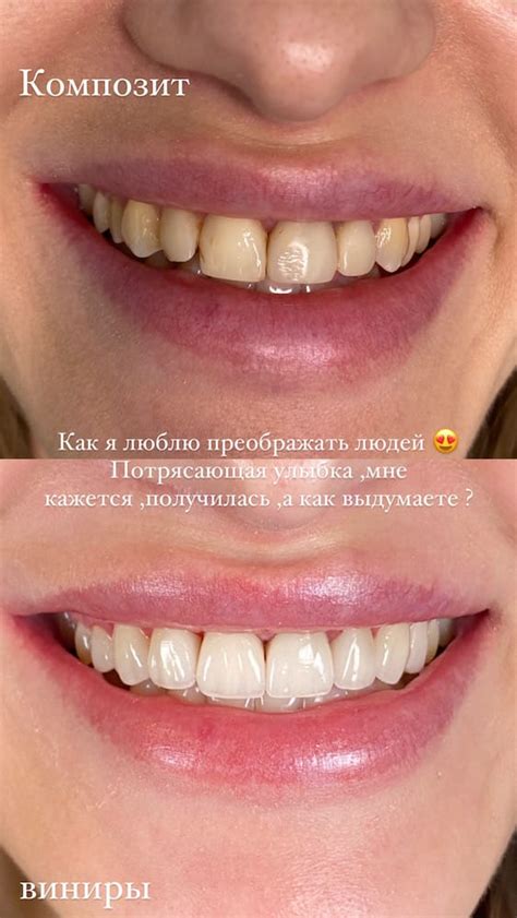 Виниры: виды, особенности установки, безопасность, показания и ...