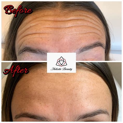Wrinkle Relaxers - Holistic Beauty