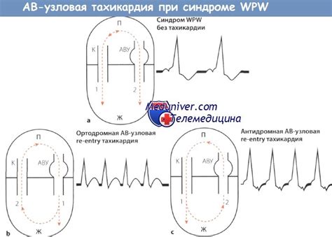 АВ-узловая пароксизмальная тахикардия при синдроме Вольфа-Паркинсона ...