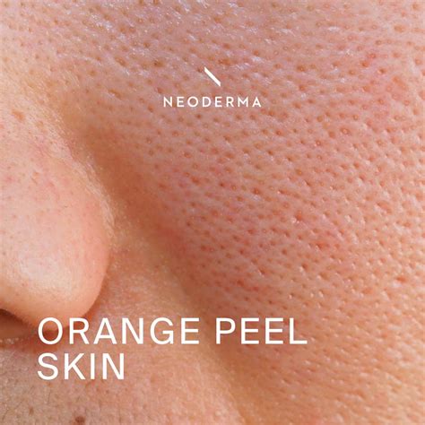 orange peel skincare routine neoderma