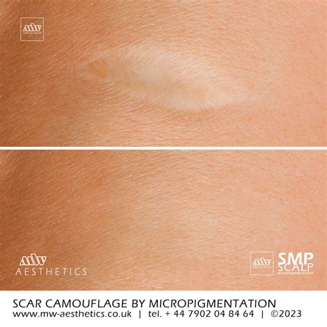 Scar Camouflage | Scar Micropigmentation | MW Aesthetics