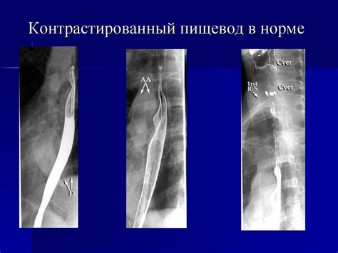 Лучевая диагностика заболеваний органов желудочно-кишечного тракта ...
