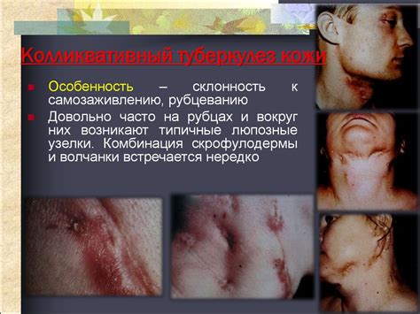 Туберкулез кожи - презентация онлайн