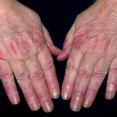 Dermatomyositis, Salt Lake City, UT | University of Utah Health ...