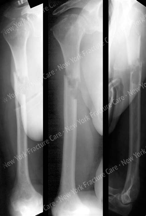 pathologic fractures  york fracture care