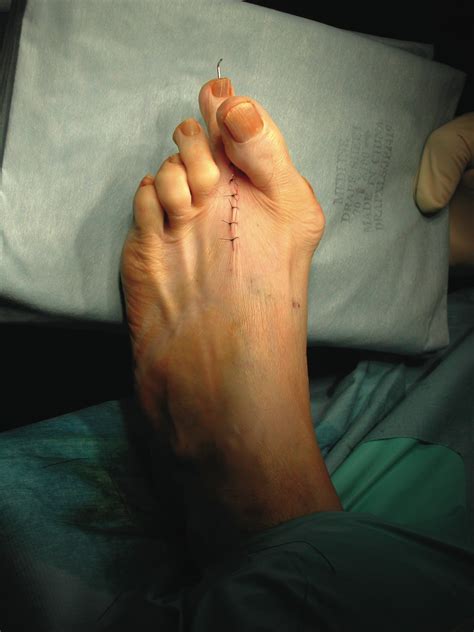 Severe Bunions