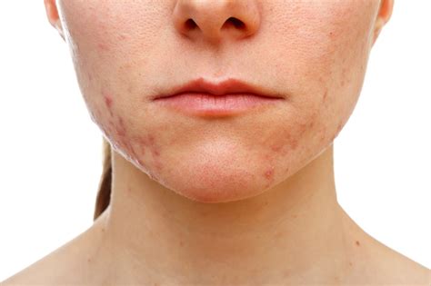 Jawline Acne – Advanced Dermatology