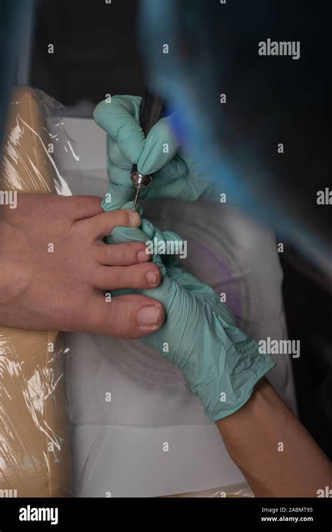 Onycholysis Nail High Resolution Stock Photography and Images - Alamy