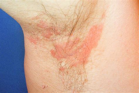 Seborrheic Dermatitis: Symptoms, Treatment, and Locations
