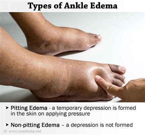 Ankle Edema / Ankle Swelling - Causes FAQs