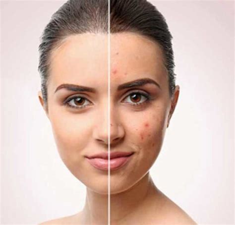 Effectiveness Of Vitamin C For Acne And Acne Scars