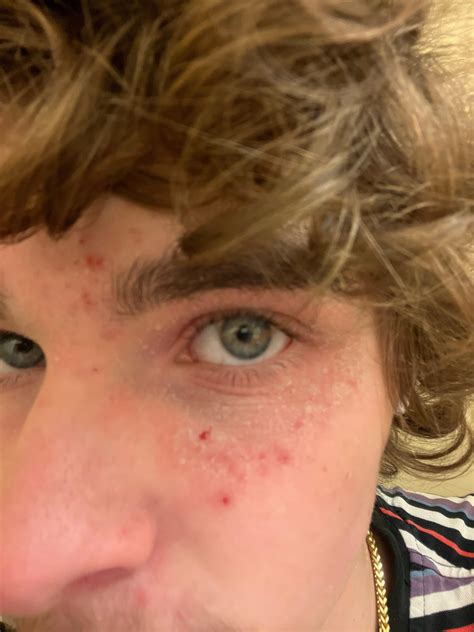 Eczema gets worse after sleeping, what do I do!! : r/eczema