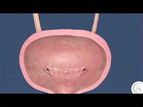 Ureterolitotripsia Rigida - YouTube