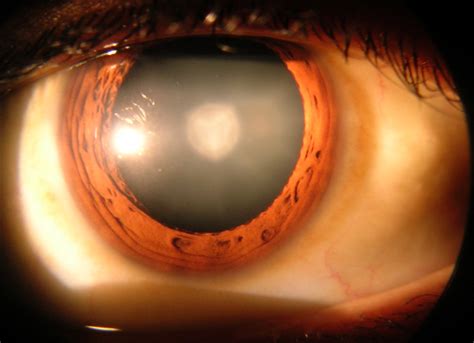 Preventing secondary cataract