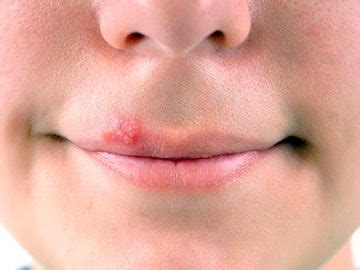 Херпес (студен) на устните на симптоми, лечение, профилактика