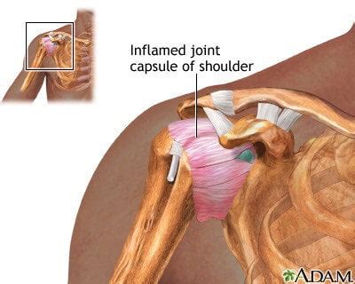 frozen shoulder treat quickly  frozen shoulder stages